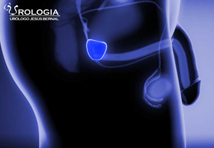 Urólogo con biopsia de próstata en Nezahualcóyotl