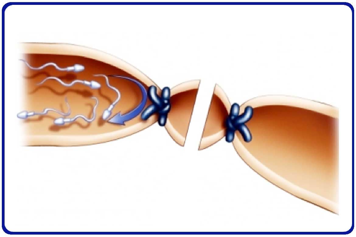 vasectomia