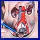 cancer de prostata